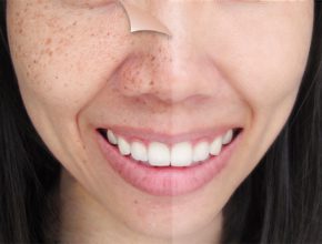 Woman's face with age spots comparison