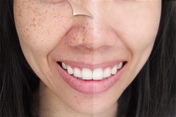 Woman's face with age spots comparison
