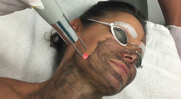 carbon peel treatment on an Asian woman's face