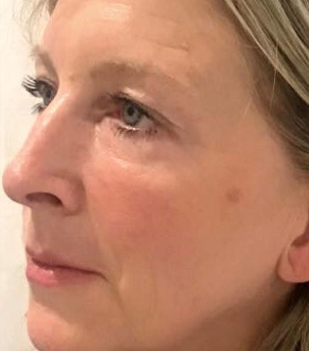 Exilis Elite after 6