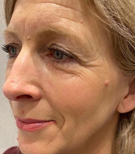 Exilis Elite before 6