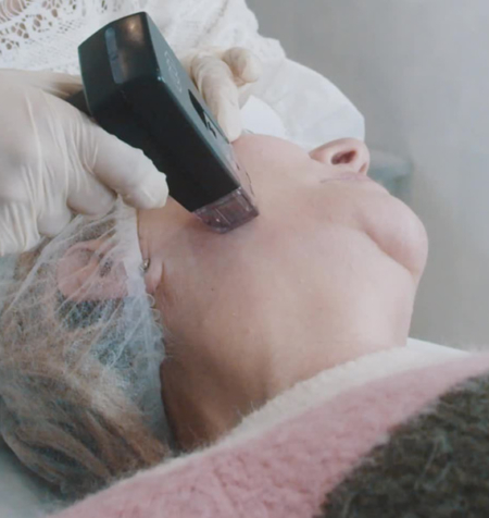 Morpheus8 Treatment