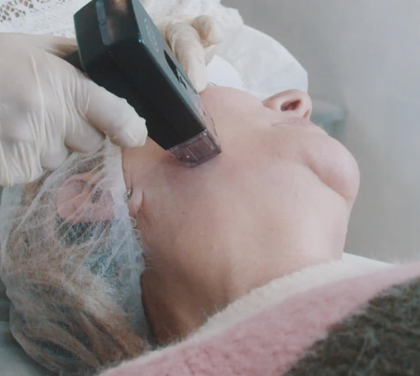 Morpheus8 Treatment