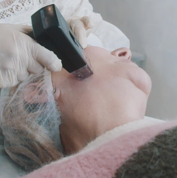 Morpheus8 Treatment
