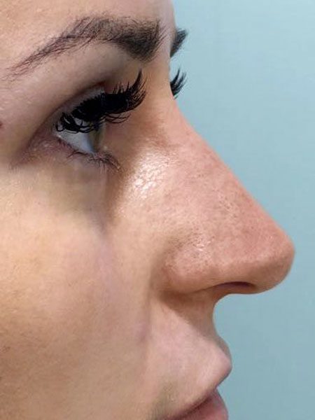 after non surgical nose rreshaping 