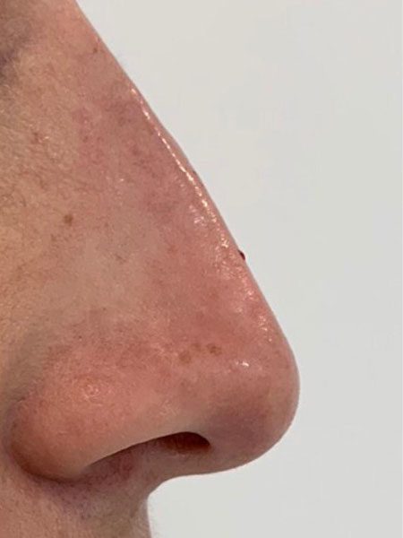 after non surgical nose rreshaping  2