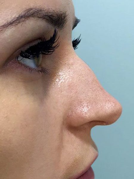before non surgical nose rreshaping 