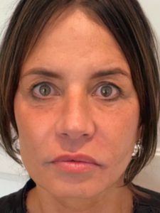 Transformational Facelift after 