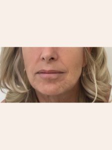 Transformational Facelift after 4