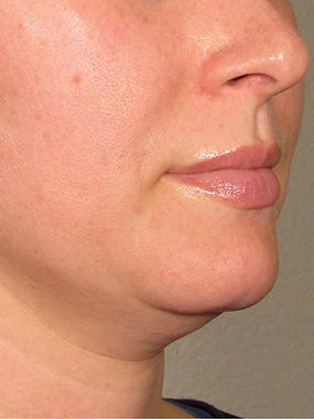 ultherapy before