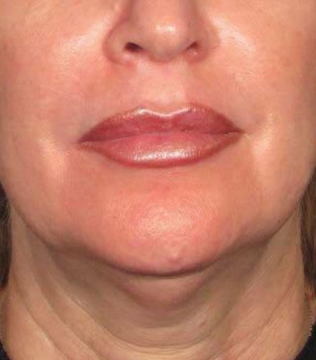ultherapy before 2