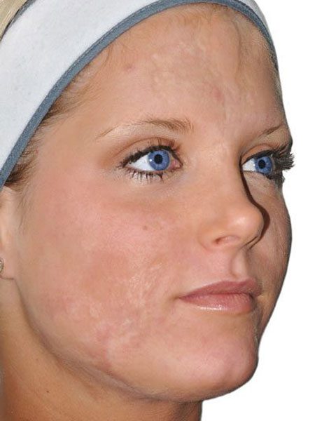 UltraPulse® CO2 Laser Skin Resurfacing - London, Cheshire & Liverpool