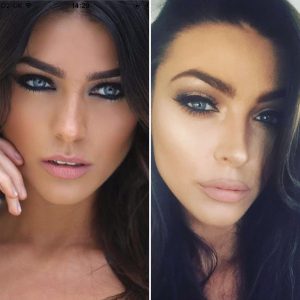 Dermal-fillers-before-and-after