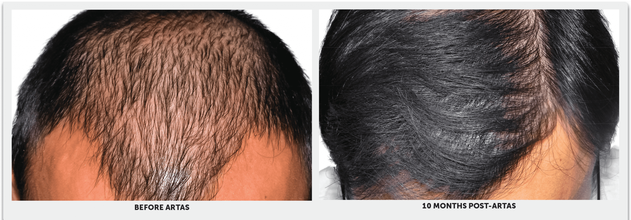 a-men-hair-before-and-after-Artas-hair-restoration-treatment