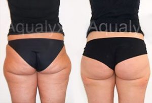 Aqualyx fat removal before and after (3)