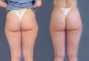 Aqualyx fat removal before and after (1).