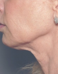 Close up of jowls after treatment