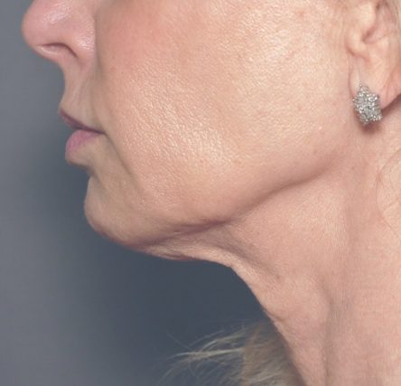 Close up of jowls after treatment