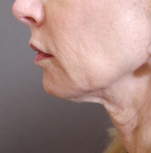 Close up of jowls before treatment