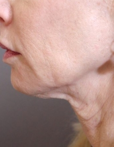 treatment for saggy neck cheshire