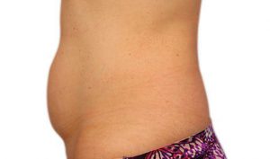 Coolsculpting fat removal abs before