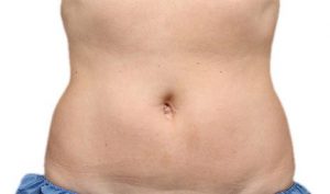Coolsculpting fat removal belly after
