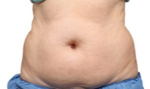 Coolsculpting fat removal belly before