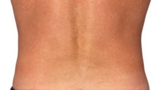 CoolSculpting Fat Removal - lower back after the treatment