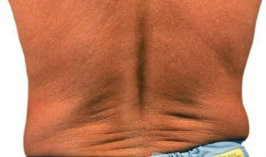CoolSculpting Fat Removal - lower back before the treatment