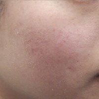 dermapen-acne-after