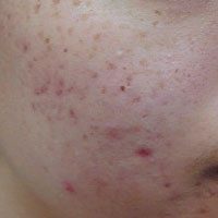 dermapen-acne-before