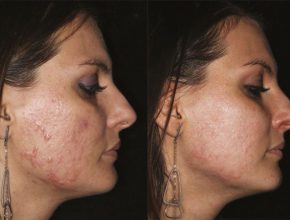 woman-face-before-and-after-acne-treatment