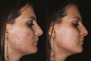 woman face before and after acne treatment