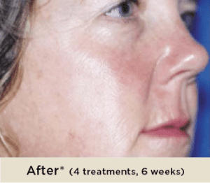 woman-after-ENVY-Facial-treatment