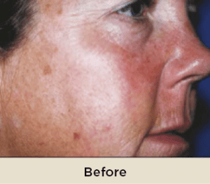 woman-before-ENVY-Facial-treatment