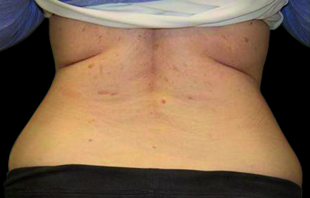 exilis-ba-back-after4tx