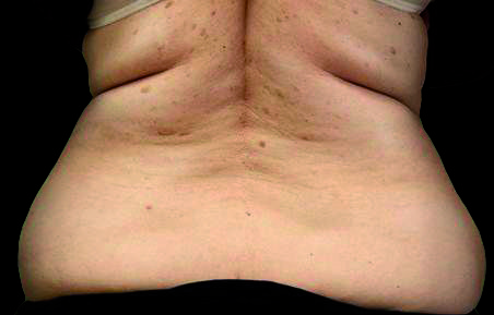 exilis treatment-back before the session