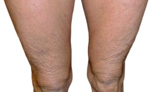 Exilis Elite Treatment - Reduce Body Fat and Tighten Skin with Dr Nyla