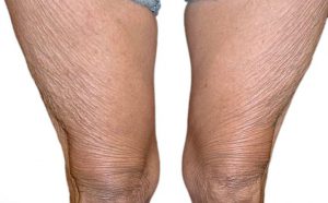 Exilis Elite Treatment - Reduce Body Fat and Tighten Skin with Dr Nyla - legs