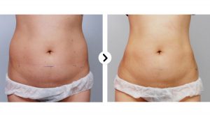 Ultraformer-3-Skin-Tightening-woman-stomach-skin-before-and-after-treatment