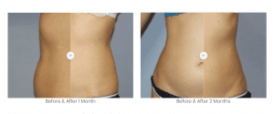 lipocel treatment areas before and after
