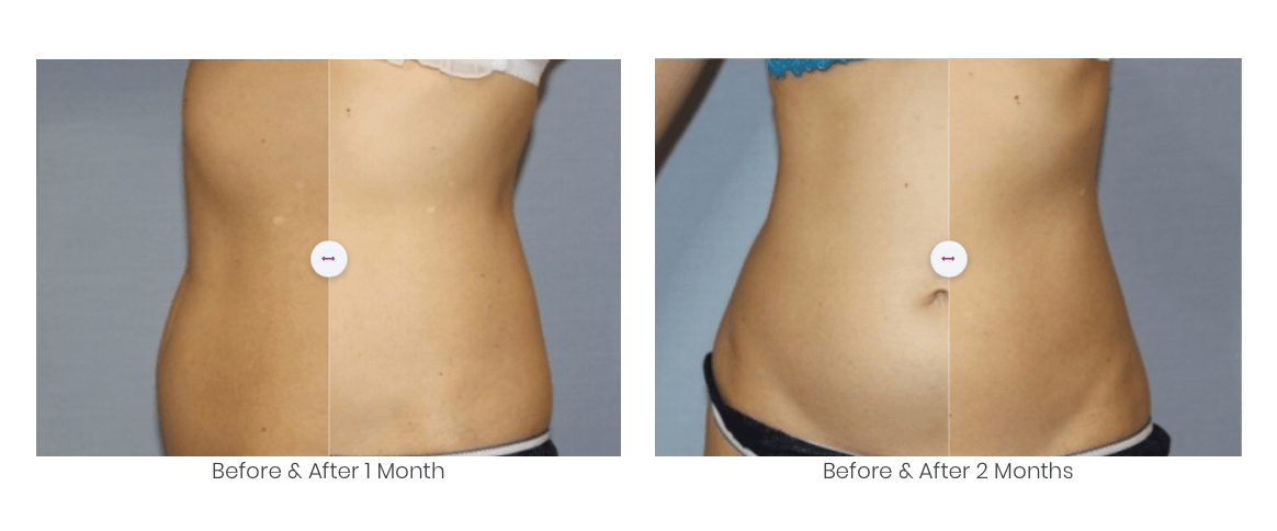 lipocel-treatment-areas