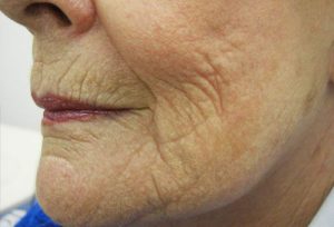 woman-lowerface-after Ultracel-treatment