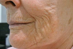 woman-lowerface-before-Ultracel-treatment