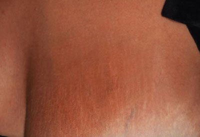 m22-chest-stretch-marks-after