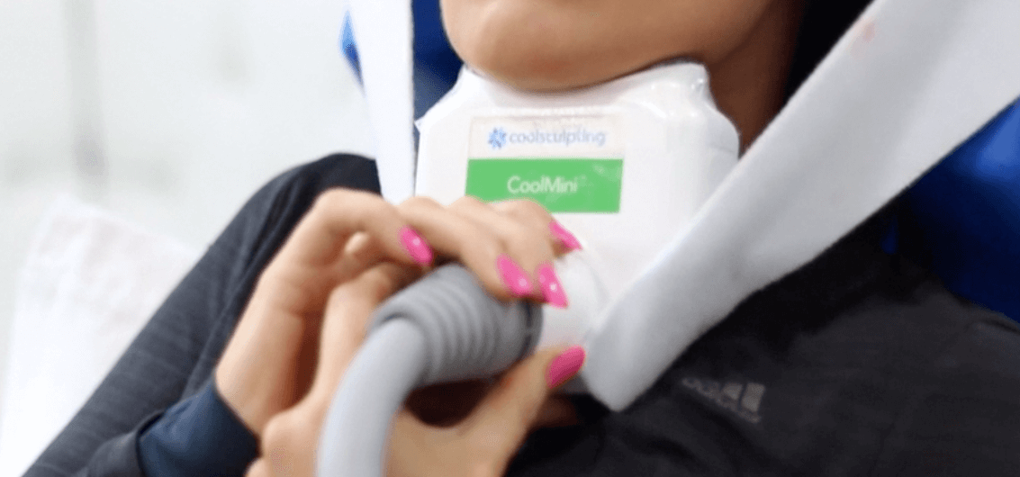 CoolSculpting fat freezing session