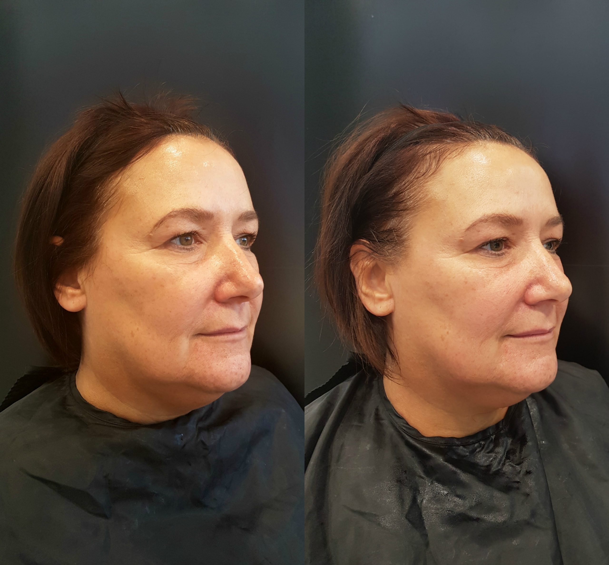 face-before-after-Ultracel-treatment