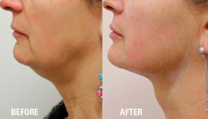 Ultraformer-3-Skin-Tightening-before-and-after