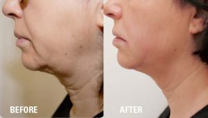 Ultraformer 3 Skin Tightening before and after