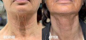 Ultraformer-3-Skin-Tightening-neck-before-and-after-skin-treatment
